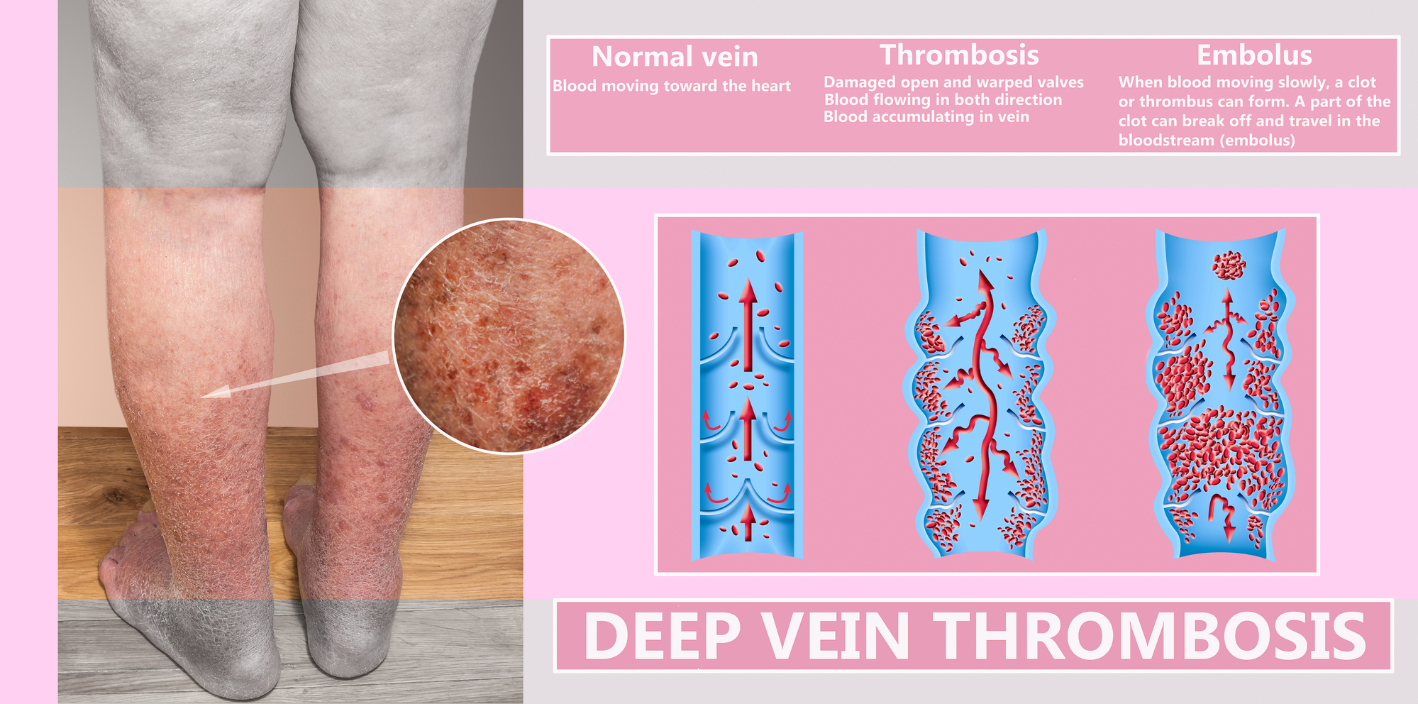 Medical, Vein Specialist, Deep Vein Thrombosis